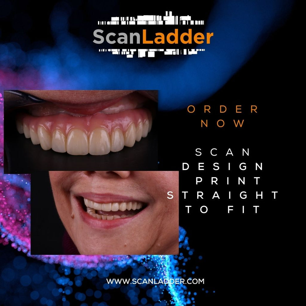 Scan Ladder INDIRECT Kit for Accurate Full Arch Dental